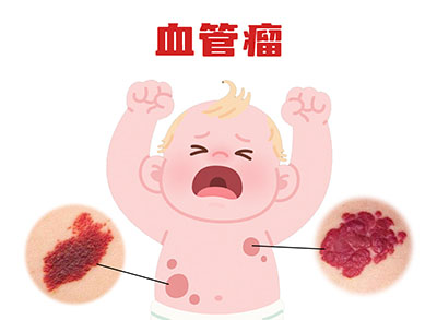 婴儿血管瘤长在眼皮上，比长在腿上更危险？
