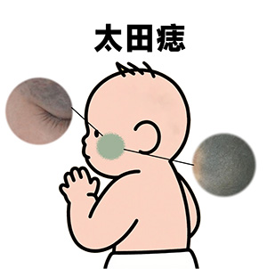 太田痣的激光治疗周期是多长？南京治疗胎记专科医院地址